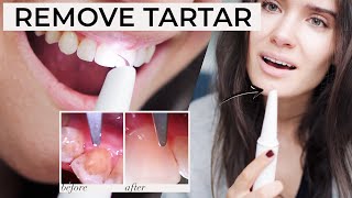 HOW TO REMOVE PLAQUE TARTAR AT HOME  Ultrasonic Tooth Cleaner Review  Does It Work [upl. by Anirba369]