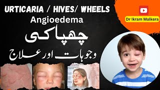 How to Treat Urticaria  Hives  Wheels Chapaki in UrduHindi  چھپاکی کی وجوہات اور علاج [upl. by Nyahs]