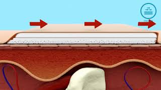 How Mepilex Border Dressing helps in Pressure Ulcer Prevention [upl. by Reteip]