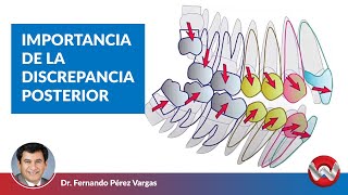 Importancia de la discrepancia posterior en su planificación de tratamiento [upl. by Bethena]