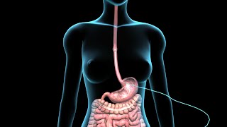 PEG  Feeding Tube  Nucleus Health [upl. by Hooke]