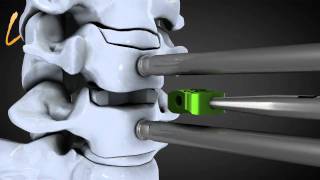 Hernie discale cervicale  Spinal disk herniation  Kisco International [upl. by Neleb]