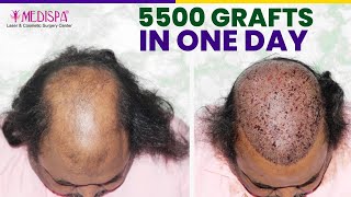 5500 Grafts Hair Transplant in Grade 6 Baldness in single sitting drsuneetsoni1 [upl. by Ayiotal]