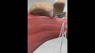 Subscapularis tendon repair  animationshorts shortsfeed youtubeshorts viralshorts [upl. by Wehttam]