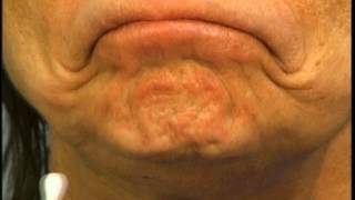 Instructions for Using Botox in the Chin by Dr Elliott of Skinspirations [upl. by Trumann]