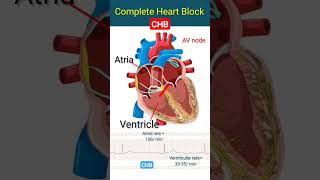 CHB l Complete heart block l ecg heartblock shorts [upl. by Eitsrik]