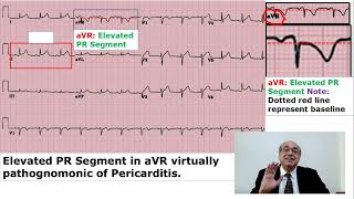 EKG Trainer Case 20 Answer [upl. by Leunamme362]