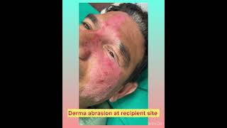 Vitiligo Surgery  Melanocyte Transplantation NCESdrlamoriaskincare [upl. by Valli]