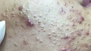 Blackheads amp Whiteheads Satisfying Removal 0053 [upl. by Mintz838]