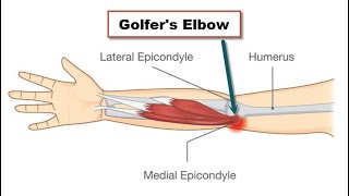 Golfers Elbow What You Need To Know [upl. by Hayashi992]