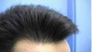 Dr Hasson Hair Transplant Surgery  2970 Grafts 1 Surgery Session  Dr Hasson [upl. by Amsed]