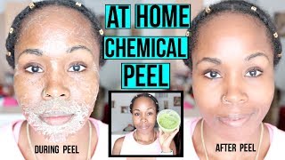 HOW TO Make a NATURAL Chemical Peel AT HOME  ERASE ACNE WRINKLES amp DARK SPOTS [upl. by Aramoix]