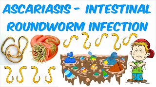 Ascariasis The Intestinal Roundworm Infection with Ascaris lumbricoides [upl. by Ettenim]