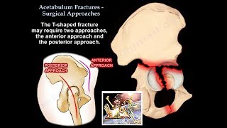 Acetabulum Fractures Surgical Approaches  Everything You Need To Know  Dr Nabil Ebraheim [upl. by Nerok940]