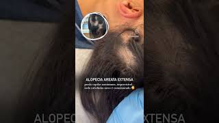 ALOPECIA AREATA [upl. by Knowling]