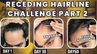 30 days HAIRLINE REGROWTH challenge PART 2  सिर्फ 1 महीने मैं RECEDING HAIRLINE REGROW करो [upl. by Leacim461]