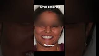 Get rid of fluorosis and gaps Improve your smile with veneers [upl. by Terris]