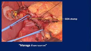 Pancreatectomy complication [upl. by Ahseenat]