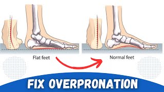 How to Correct Overpronation Fallen Arches [upl. by Konstanze]