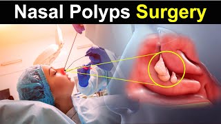 Nasal Polyps Removal  Causes SymptomTreatment amp Surgery  POLYPECTOMY  3D VIDEO ANIMATION [upl. by Arahsit830]