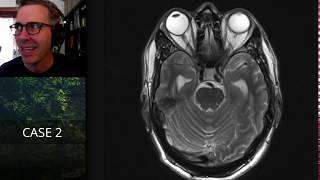 Isolation tutorial Neuroradiology with Frank Gaillard [upl. by Lebasile]