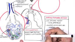 PART I  Pneumonia Overview Lobar and Bronchopneumonia [upl. by Kass]