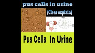 Why Pus Cells Comes In Urine  CuasesOfPusCells Causes Symptoms Treatment [upl. by Speroni690]