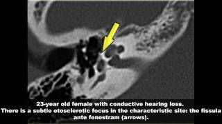 Temporal Bone Radiology Case Review [upl. by Liew]