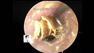 Postoperative cleaning of cholesteatoma [upl. by Mohammed871]