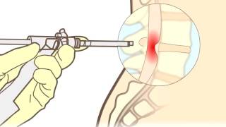 Hernia discal ¿qué es ¿Cómo se opera  Neurocirugía Torres [upl. by Ruby]