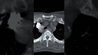 CTA pulmonary arterymedicalanimation medicalimaging medicaltest ctscan angiography [upl. by Atinrev230]