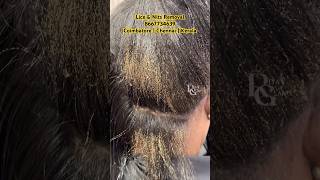 How to remove lice from hairhow to treat lice amp nitslice removallice treatment in Coimbatorelice [upl. by Carolann855]