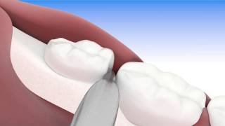 Exodoncia compleja tercer molar semi incluido  Video 3D PASO A PASO [upl. by Hanavas]