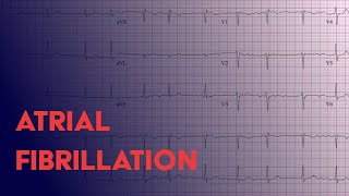 Atrial Fibrillation Afib  EKG ECG Interpretation [upl. by Sillyrama]