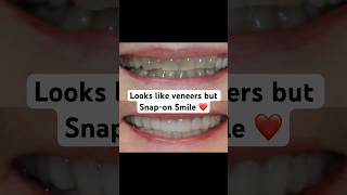 When they look like veneers but are amazing removable cosmetic appliance ❤️ [upl. by Jonette]