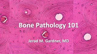 Bone Tumor Pathology 101 Osteosarcoma Chondrosarcoma and Mimics [upl. by Sculley]