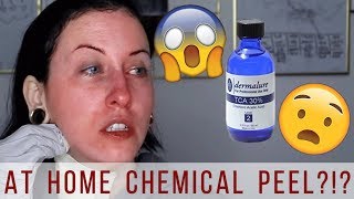 How to Do a TCA Peel at Home  TCA 30 Chemical Peel  Before amp After Results [upl. by Wilkinson]