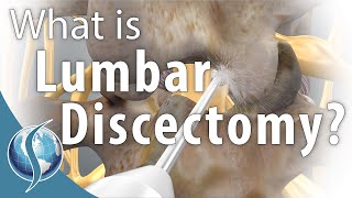 Lumbar Discectomy [upl. by Grogan158]