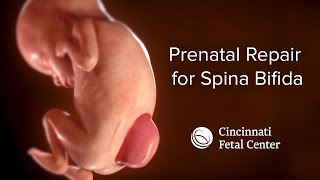 Spina Bifida Medical Animation  Cincinnati Fetal Center [upl. by Shaffert]