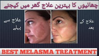 Treat Melasma At Home  Best Melasma Treatment  Dr shahzad Hashmi Lecture 107 [upl. by Naehgem]