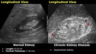 Kidney Ultrasound Normal Vs Chronic Kidney Disease CKD Imaging Findings  Chronic Renal Failure [upl. by Louie]