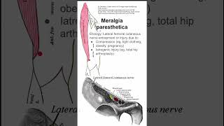 Meralgia paresthetica [upl. by Nylassej]