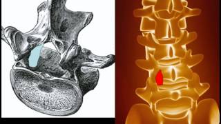 Behandlung der Spinalkanalstenose [upl. by Negam]