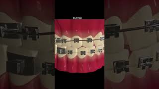 How Does Dental Braces Work 🦷 डेंटल ब्रेसेस कैसे काम करते हैं  dentist braces  shorts [upl. by Serene]