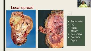 Renal Cell Carcinoma and Wilms Tumor  Renal Pathology  RATS in Pathology [upl. by Modestia]