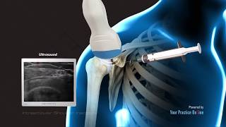 Intraarticular Shoulder Injection [upl. by Elo]