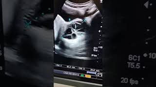 multiple septated adnexal cysts ovarian cystspelvis ultrasound gynaelogical ultrasound [upl. by Anivlem]