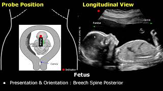 Obstetric Ultrasound Probe Positioning  Pregnant Uterus amp Fetus Transducer Placement USG Scan [upl. by Henebry35]