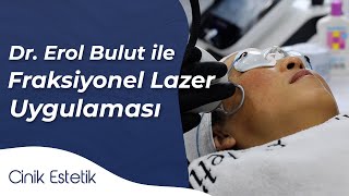 Cinik Estetik  Fraksiyonel Lazer Uygulaması [upl. by Eleik]