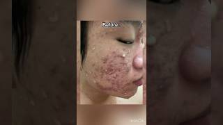 1 year before after severe acne isotretinoin journey jerawat isotretinoin acne [upl. by Goldi225]